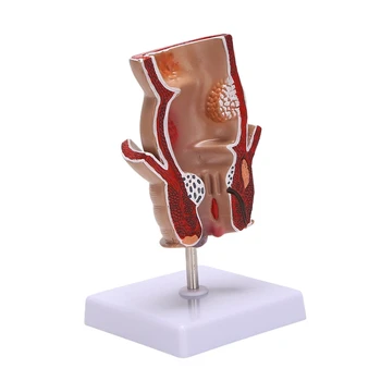 Anatómiai modell Emberi rektális aranyér lézió modell Hemorrhoid fistula fistula hasadék patológia tanítási modell